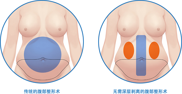 腹部整形，为什么最少剥离很重要？